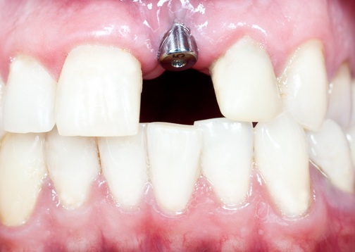 mi-a cazut bontul de vindecare