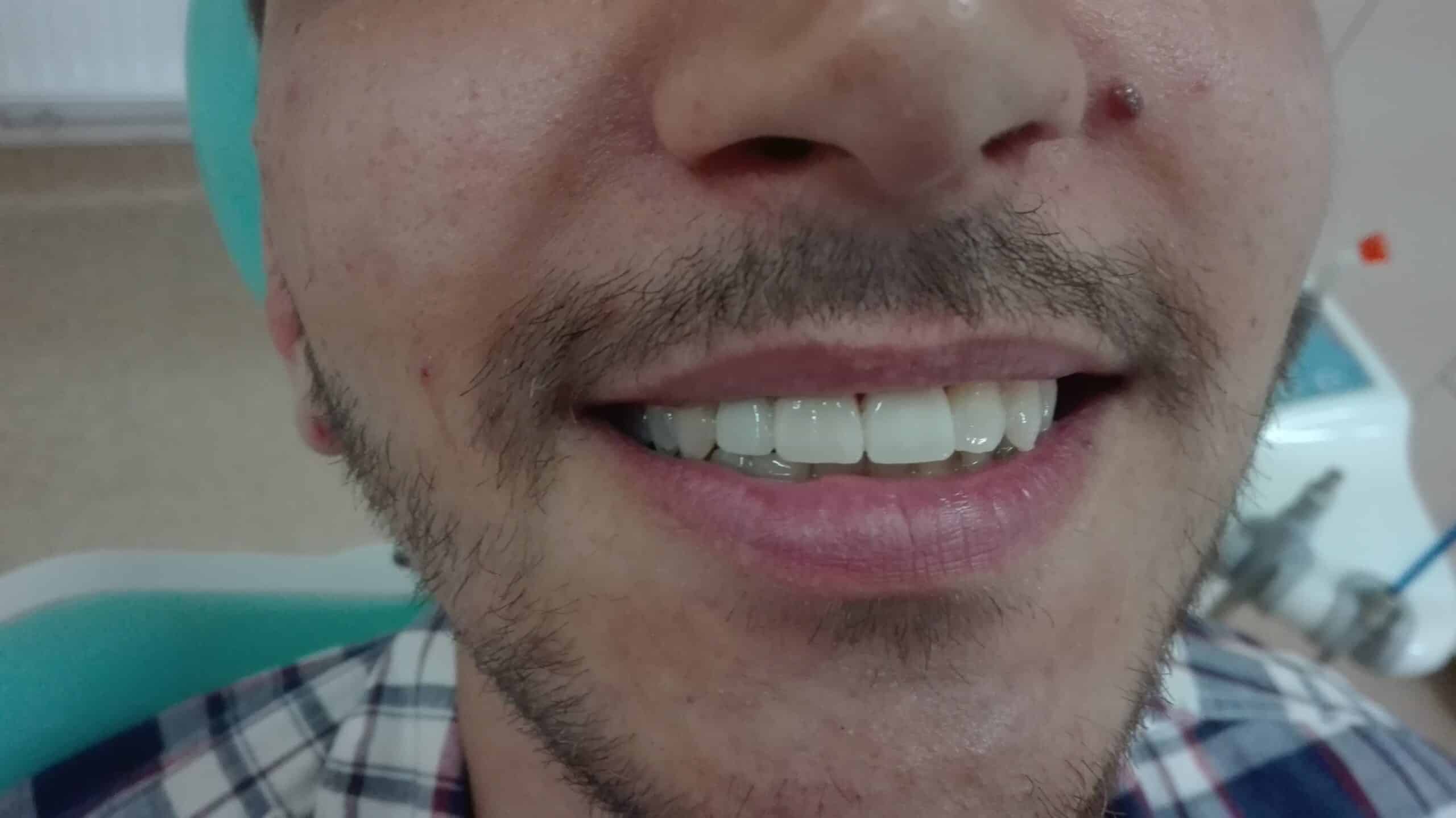 avantajele și dezavantajele coroanelor de zirconiu și ceramică